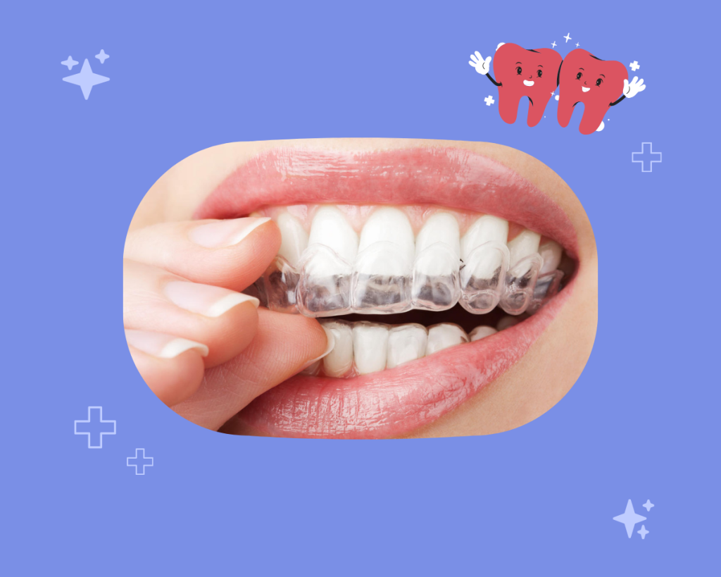 Gouttière de nuit pour redresser les dents : est ce que ça fonctionne