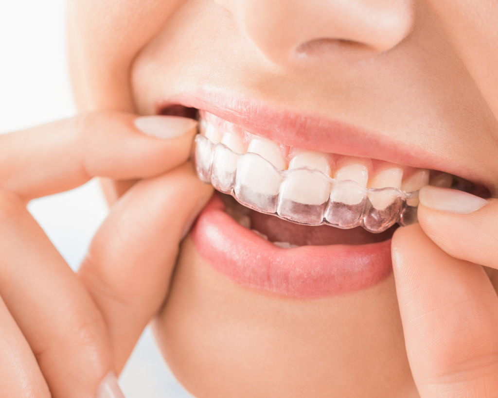 Redresser ses dents soi-même, c'est possible